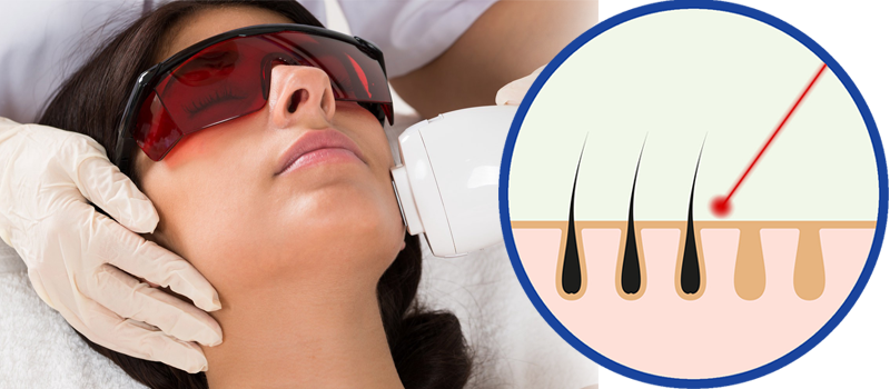 why laser hair removal